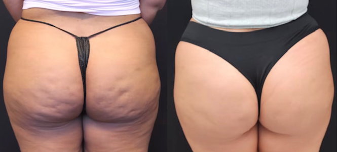 Aveli Cellulite Treatment